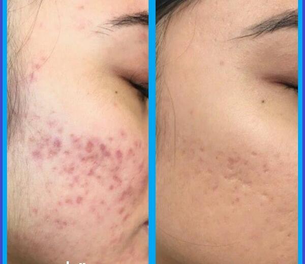 عکس قبل و بعد پاکسازی صورت