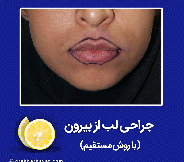 عکس لب قیطونی