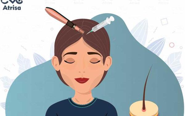 عکس کارتونی کاشت مو