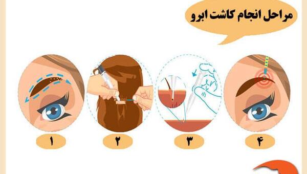 عکس کارتونی کاشت مو