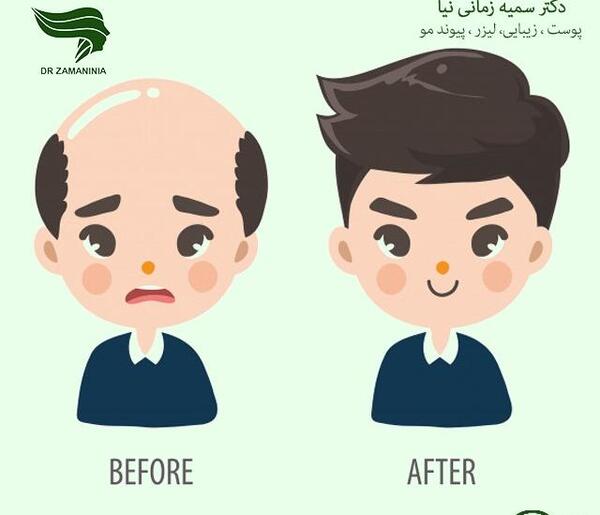 عکس کارتونی کاشت مو