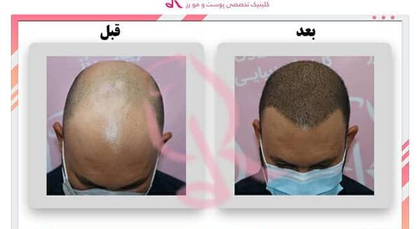 عکس کارتونی کاشت مو