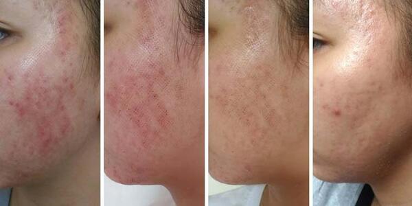 عکس قبل و بعد از لیزر جای جوش