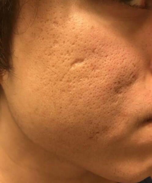 عکس قبل و بعد از لیزر جای جوش