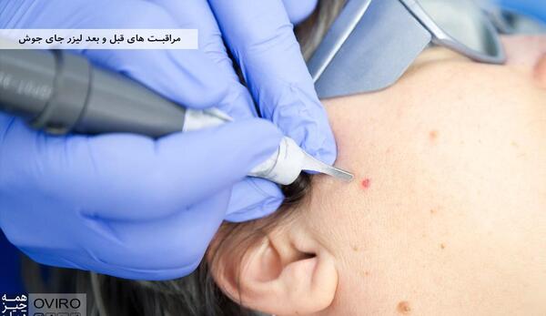 عکس قبل و بعد از لیزر جای جوش