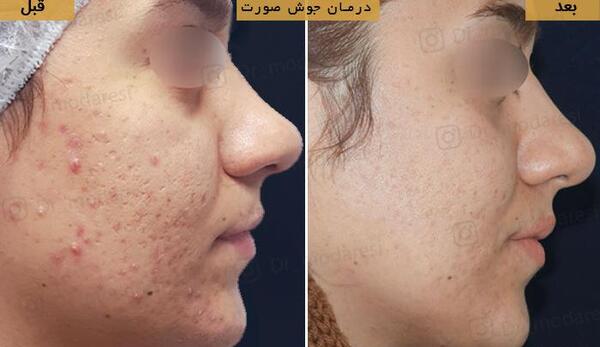 عکس قبل و بعد از لیزر جای جوش