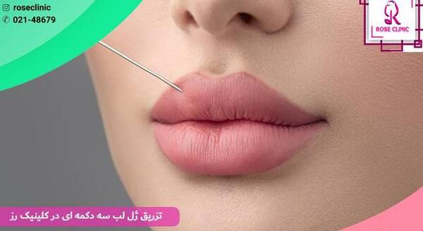 عکس لب های ژل زده