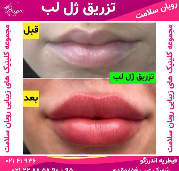 عکس لب های ژل زده