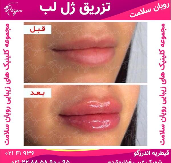 عکس لب های ژل زده