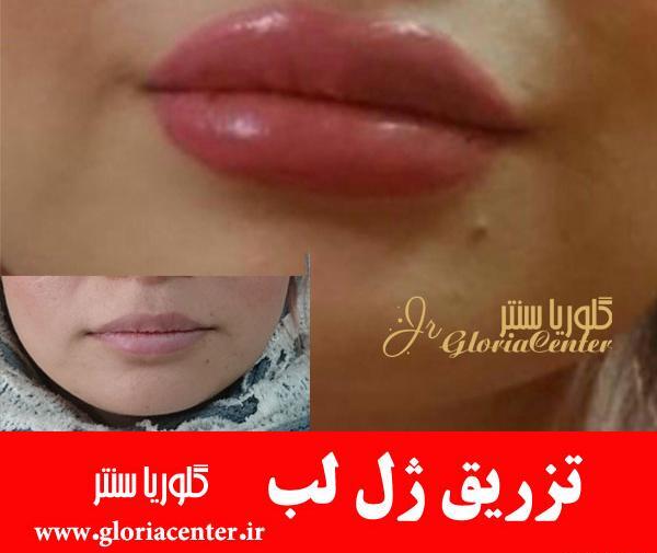 عکس لب های ژل زده