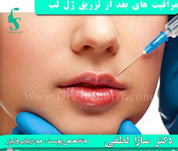 عکس لب های ژل زده