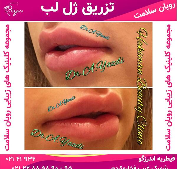 عکس لب های ژل زده