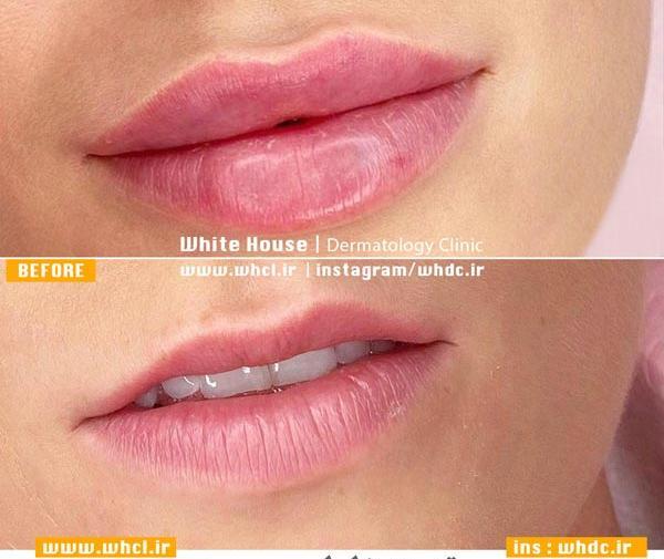 عکس لب های ژل زده