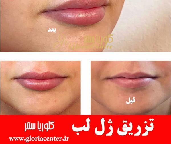 عکس لب های ژل زده