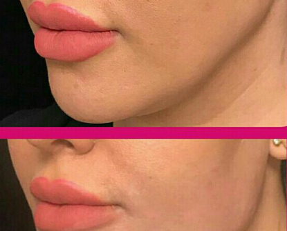 عکس لب ژل تزریق شده