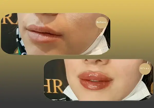عکس لب ژل تزریق شده