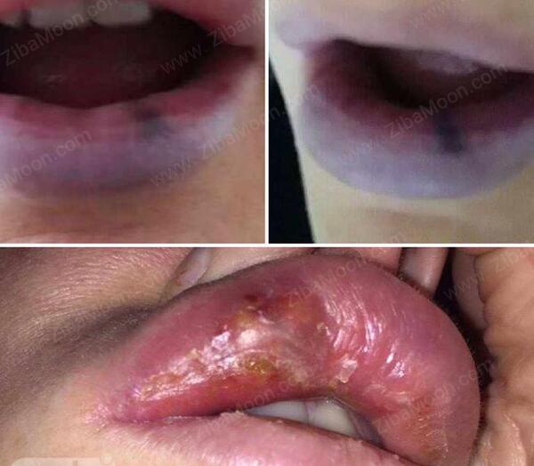 عکس لب ژل تزریق شده