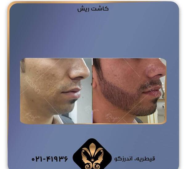 عکس ریش طبیعی
