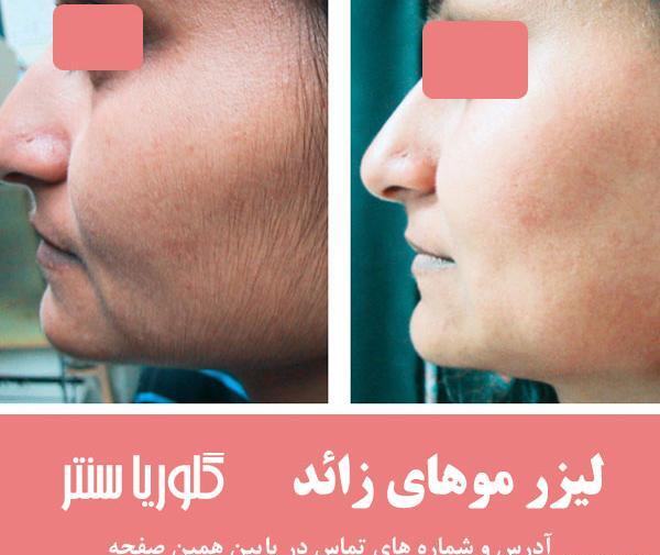 عکس لیزر موهای صورت
