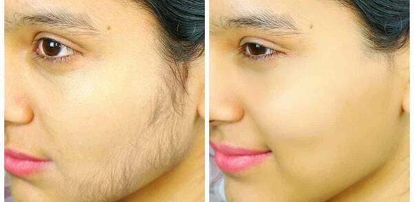 عکس لیزر موهای صورت