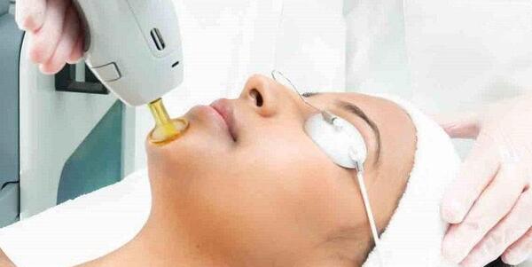 عکس لیزر موهای صورت