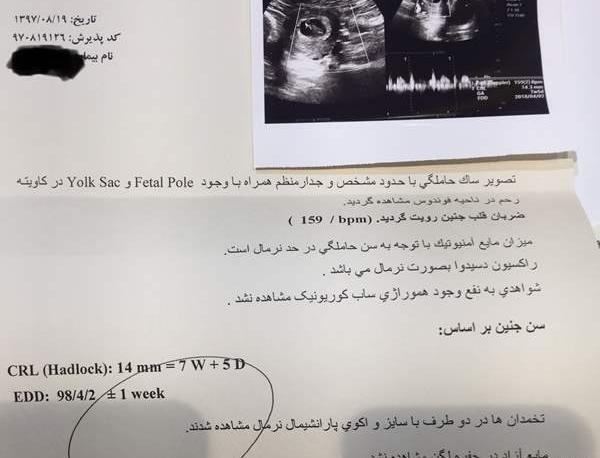 عکس ضربان قلب جنین دختر