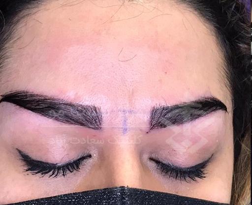 عکس کاشت ابروی طبیعی