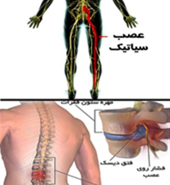 عکس ام ار ای سیاتیک