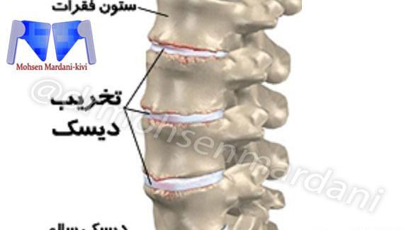 ستون فقرات عکس ام ار ای دیسک کمر سالم