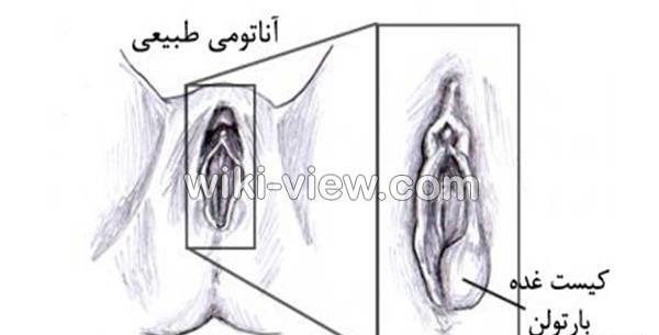عکس واقعی کیست بارتولن