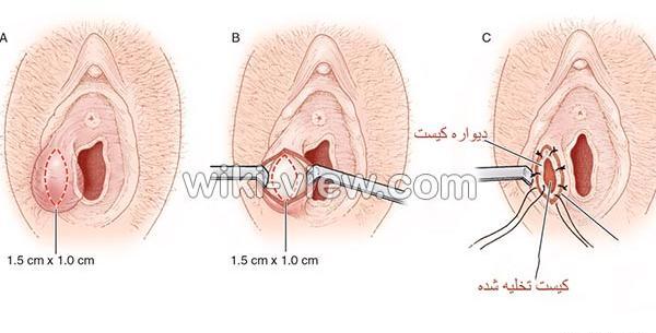 عکس واقعی کیست بارتولن