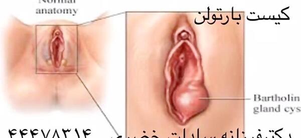 عکس واقعی کیست بارتولن