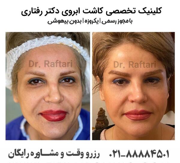 عکس کاشت ابرو بعد از چند ماه