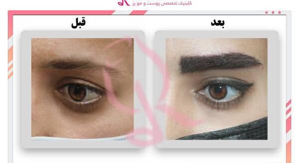 عکس کاشت ابرو بعد از چند ماه