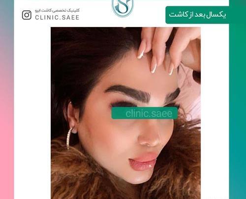 عکس کاشت ابرو بعد از چند ماه