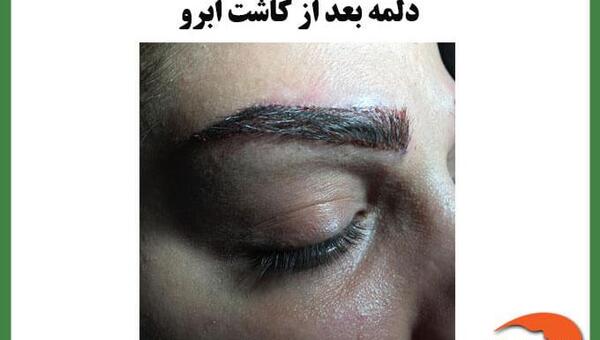 عکس کاشت ابرو بعد از چند ماه