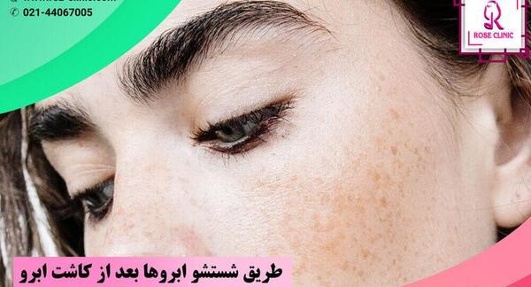 عکس کاشت ابرو بعد از چند ماه