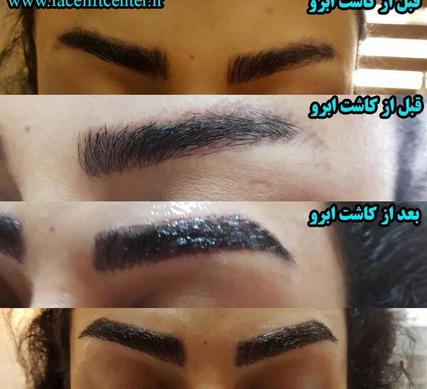 عکس کاشت ابرو بعد از چند ماه