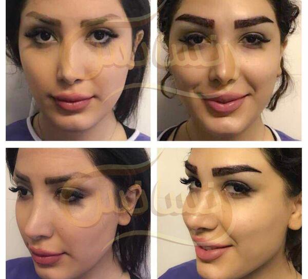 عکس کاشت ابرو بعد از چند ماه