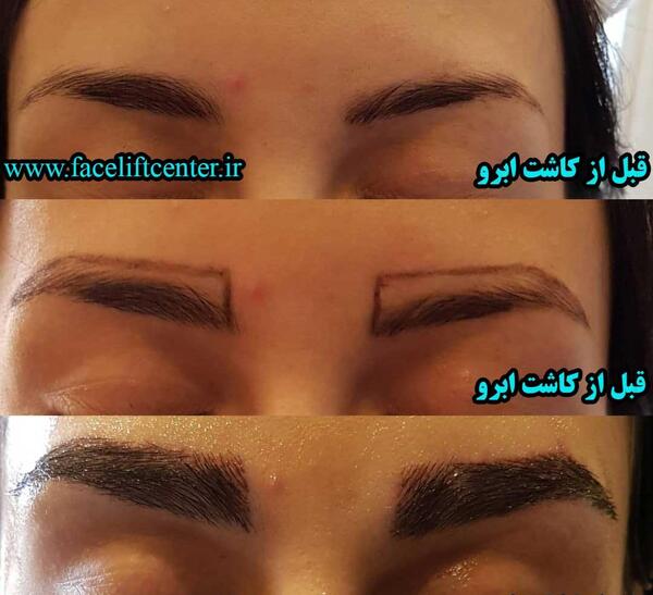 عکس کاشت ابرو بعد از چند ماه