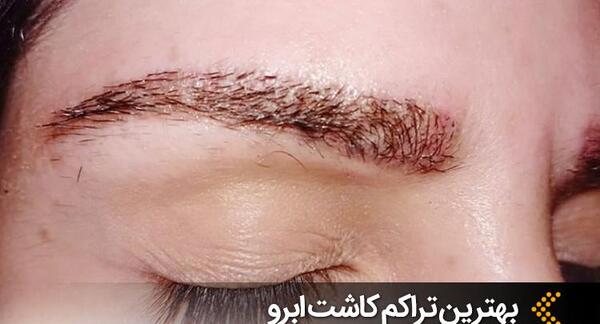 عکس کاشت ابرو بعد از چند ماه