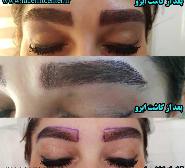 عکس کاشت ابرو بعد از چند ماه