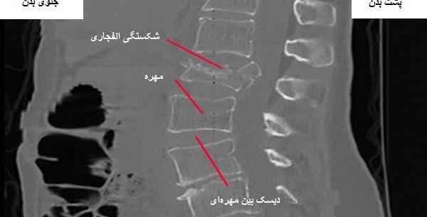 عکس ام ار ای شکستگی مهره کمر
