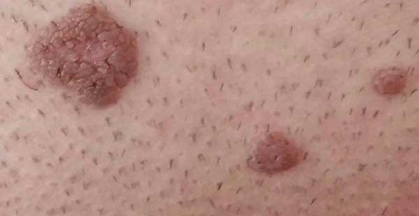 عکس ویروس hpv