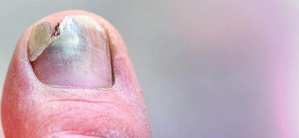 عکس ناخن شکسته پا