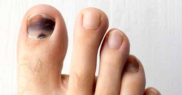 عکس ناخن شکسته پا