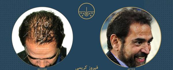 عکس احسان علیخانی قبل کاشت مو