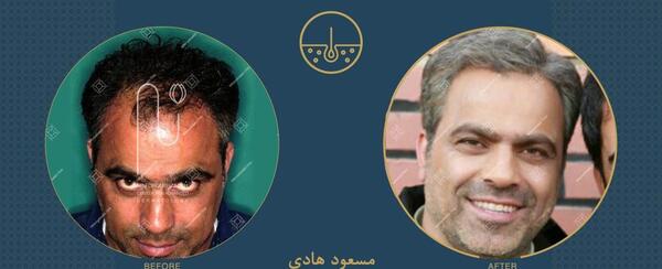 عکس احسان علیخانی قبل کاشت مو