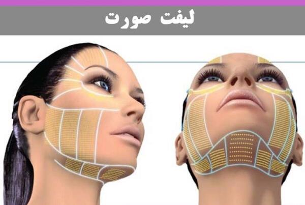 عکس لیفت صورت قبل و بعد
