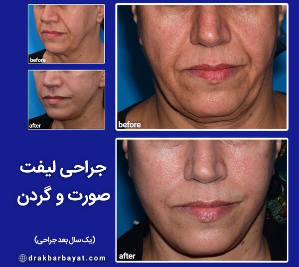 عکس لیفت صورت قبل و بعد